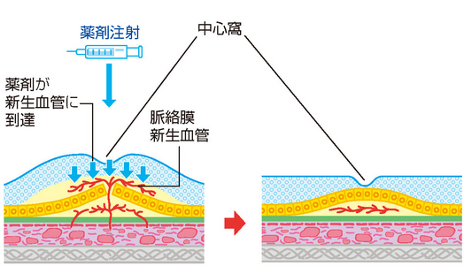 レーザー治療