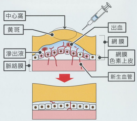 アイリーアによる治療法