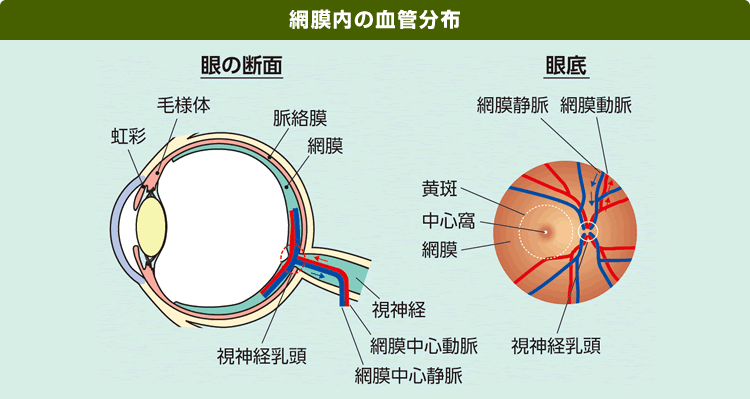網膜静脈閉塞症
