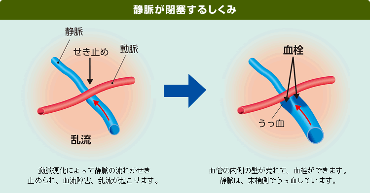 網膜静脈閉塞症
