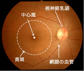 加齢黄斑変性