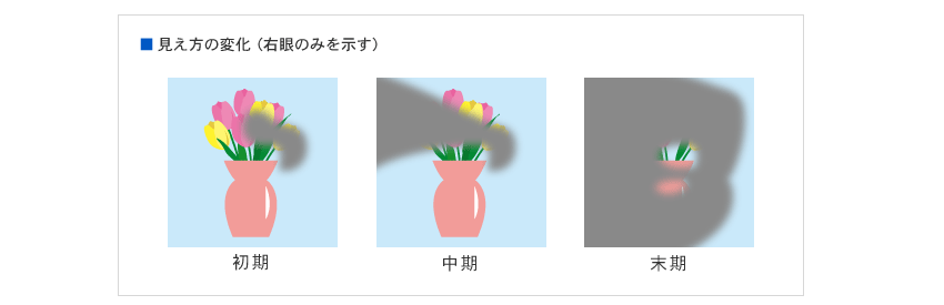 緑内障とは