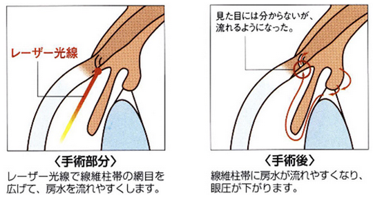 SLTの仕組み